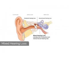 What is mixed hearing loss! Symptoms and treatment